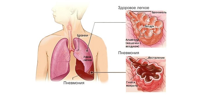 Общие сведения о заболеваниях легких Пневмания