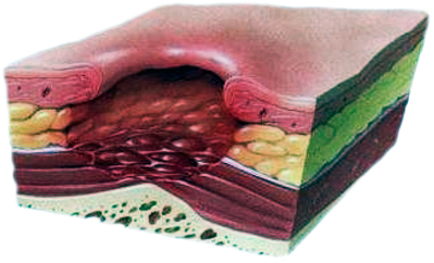 Четвертая степень пролежней. Стерильно.com