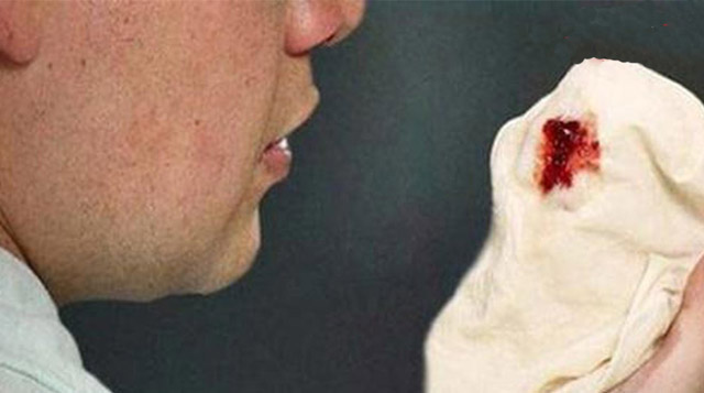 Пневмония мокрота с прожилками крови