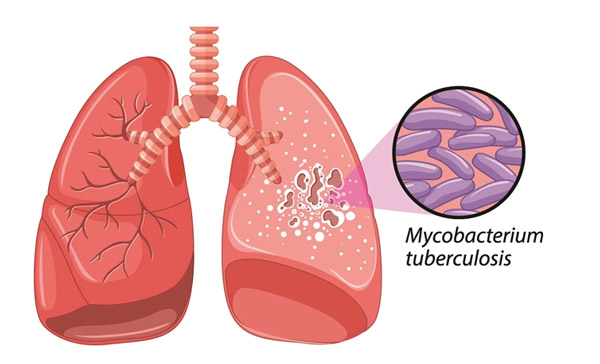 Пневмония мокрота с прожилками крови