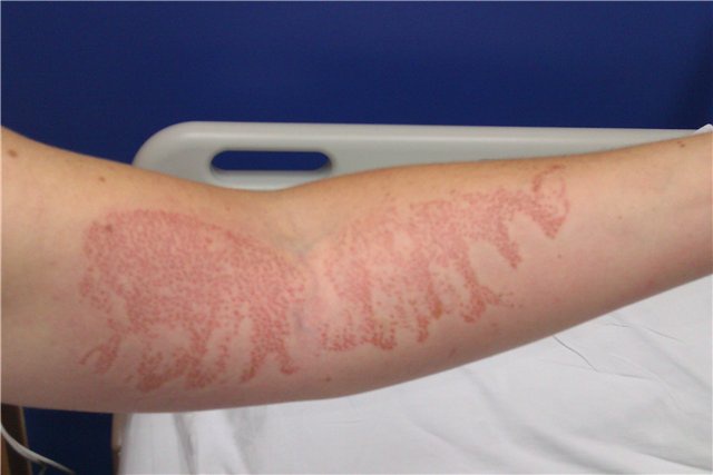 ожог от медузы