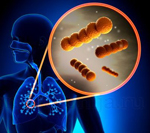 Пневмония Пневмония