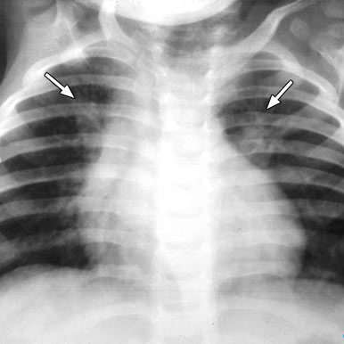 Двусторонняя пневмония у тяжелых больных