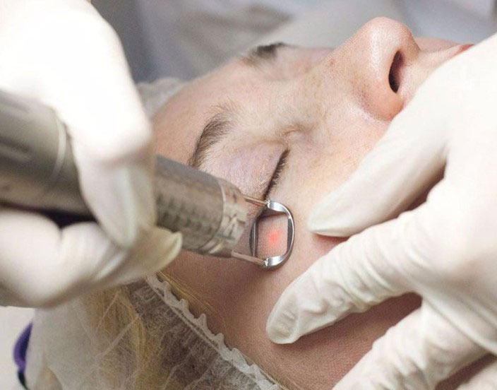 Удаление шрама после ожога цена