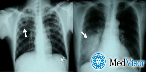 Отличия пневмонии от туберкулеза на рентгене Рентген туберкулез или пневмония как