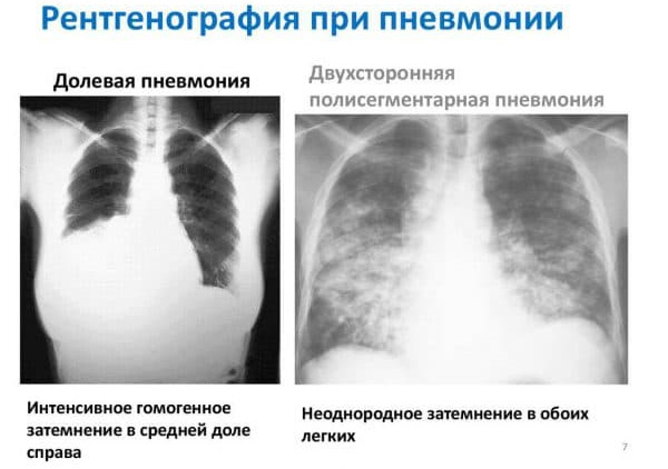 Двусторонняя пневмония у тяжелых больных
