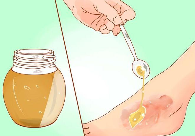 можно ли обрабатывать ожог перекисью