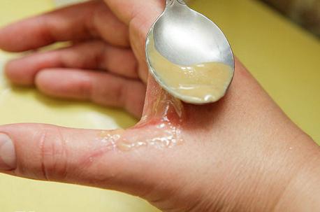 чем обработать солнечный ожог