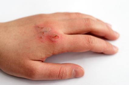 чем обработать ожог в домашних условиях