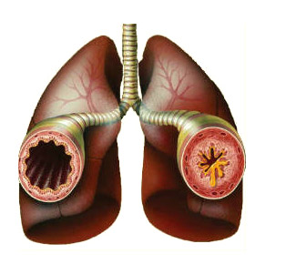 Пневмония мокрота с прожилками крови