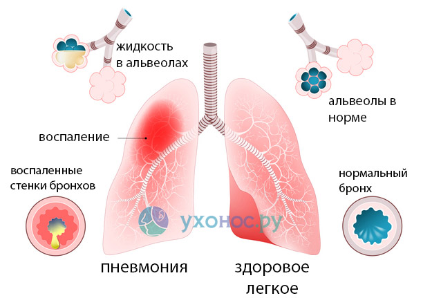Двусторонняя пневмония у тяжелых больных