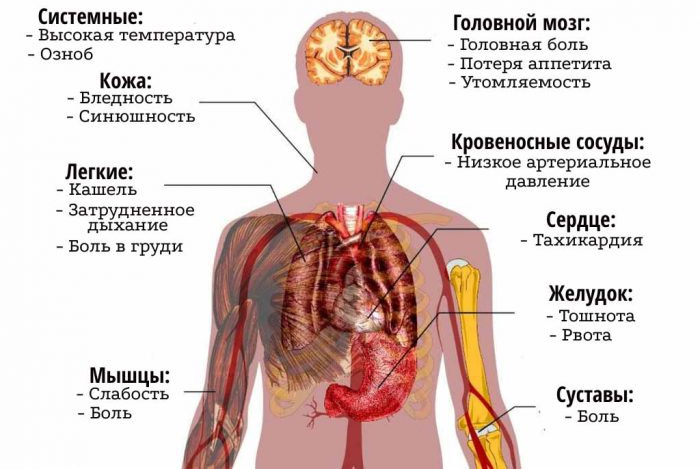 Двусторонняя пневмония у тяжелых больных