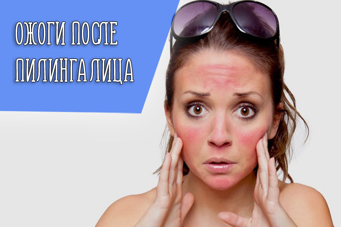 Причины появления ожога