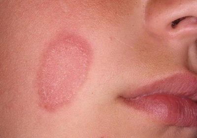 Фотографии ожогов