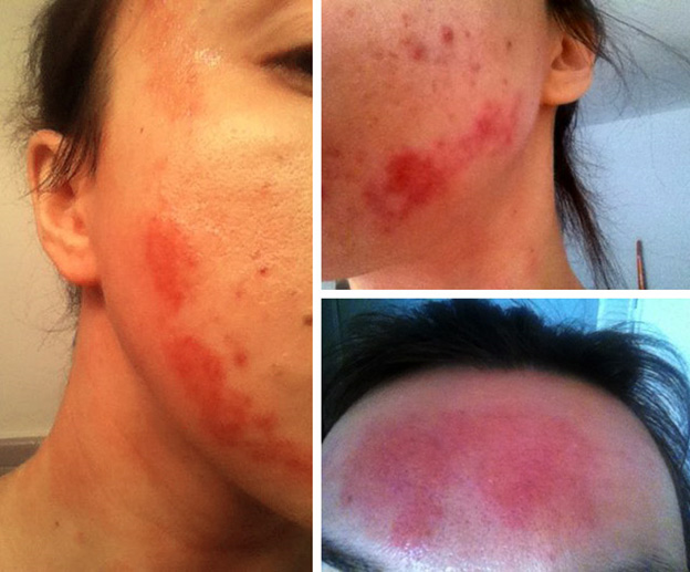 Фотографии ожогов