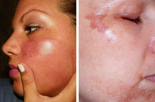 Фотографии ожогов