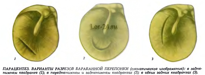 Варианты разрезов барабанной перепонки