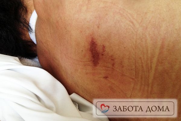 Пролежень Пролежень