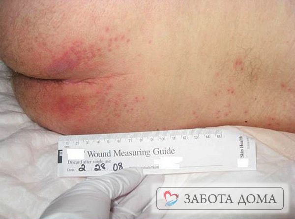 Основные симптомы пролежней начальной стадии - изменение цвета сдавливаемых участков кожи и появление уплотнений. Пролежень первая стадия