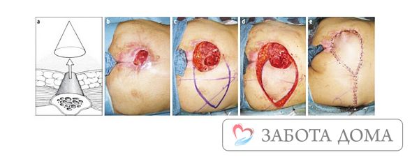 Хирургическое вмешательство в лечение пролежневых ран подразумевает вскрытие гнойников, обеспечение дренирования ран и антисептическую обработку. Хирургическое вмешательство в пролежни 3 и 4 стадии