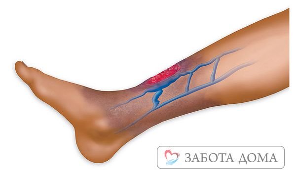 Трофическая язва Трофическая язва