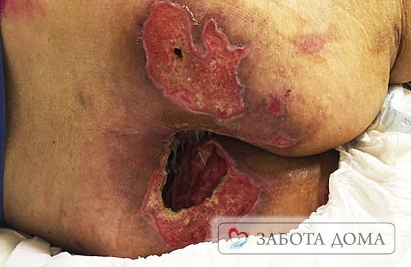 Пролежень при смерти Пролежень при смерти