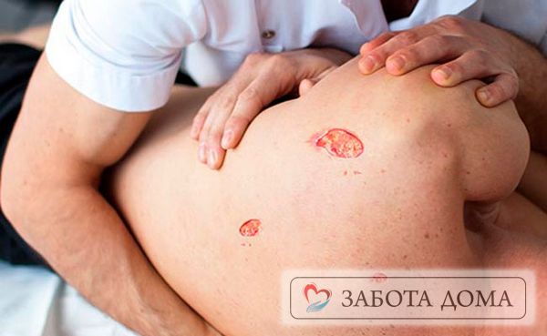 Пролежни на спине