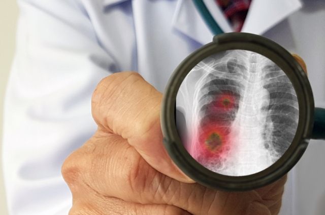 Можно ли работать с пневмонией