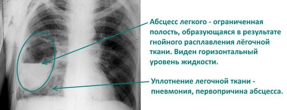 Абсцесс лёгкого Абсцесс лёгкого