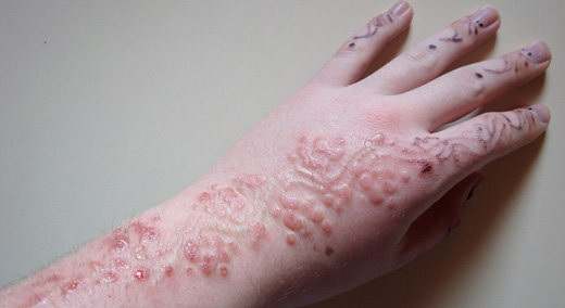 аллергия на хну