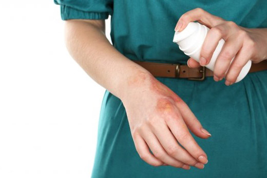 лечение ожогов