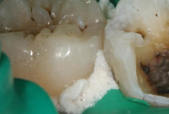 мышьяк возле зуба