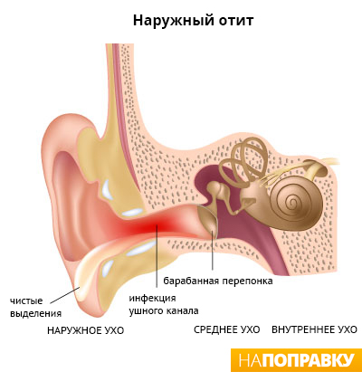 наружный отит.jpg анатомия уха, симптомы наружного отита
