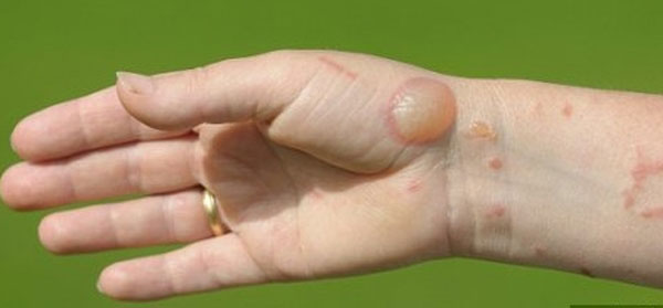 волдыри от ожога медузы