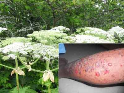 борщевик, ожоги борщевик, ожоги