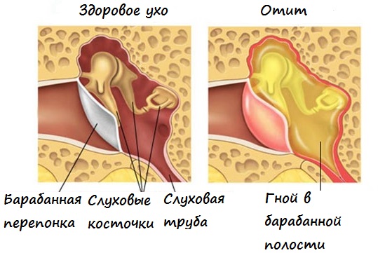 Что такое отит?