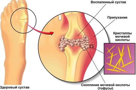 Накопление мочевой кислоты