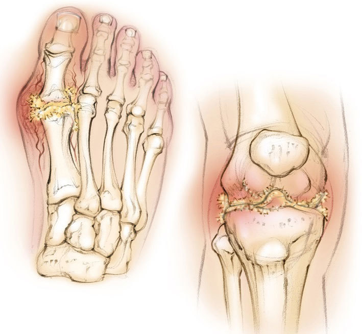 Идеальная диета для людей, страдающих от подагры Идеальная диета для людей, страдающих от подагры