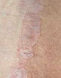 Удаление рубца фракционным лазером <a href='/services/omolozhenie/frakcionnyj-termoliz-fraxel'>Fraxel</a> после процедуры