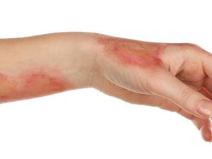 Лечение ожога 2 степени антибиотиками