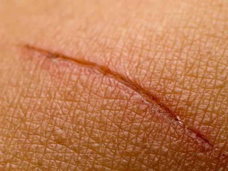 Лечение коллоидных рубцов Лечение коллоидного рубца