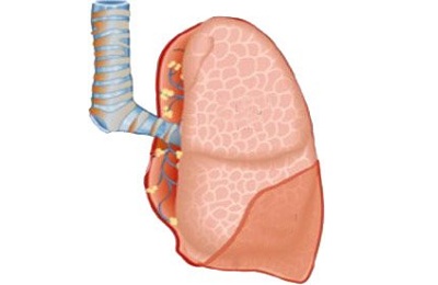 Воспаление плевры
