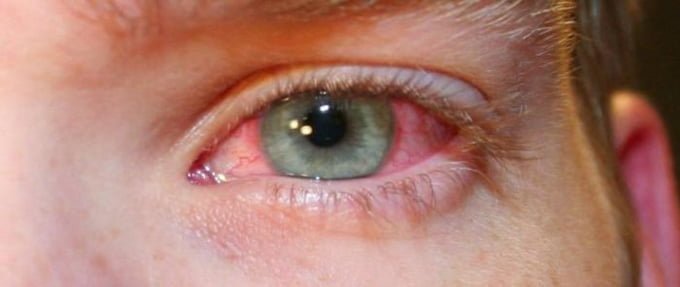 Веко глаза как будто ожог Веко глаза как будто ожог thumbnail