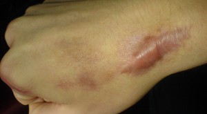 Консервативное лечение Избавления от рубцов