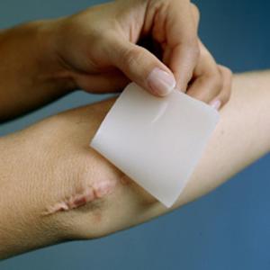 Причины появления коллоидных рубцов Причина появления коллоидных рубцов