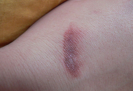 след от термического ожога