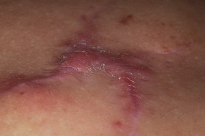 Профилактика рубцов Профилактика заболевания