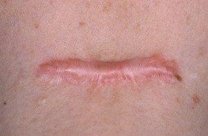 Удаление рубца лазером Метод удаления рубцов лазером