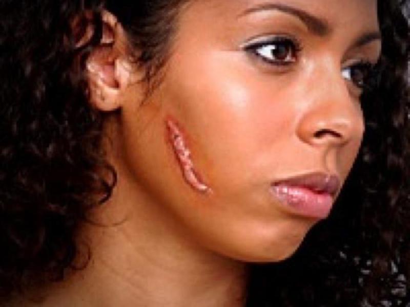 Коллоидные рубцы: причины образования и методы лечения. Причины возникновения коллоидого рубца