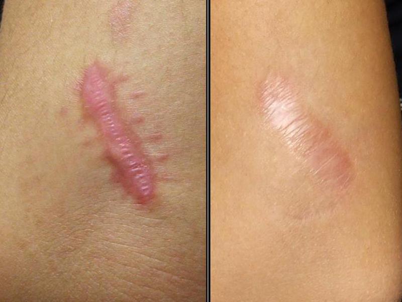 Лечение коллоидных рубцов. Чем можно вылечить коллоидный рубец